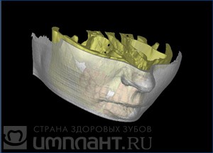 Что такое синус-лифтинг?